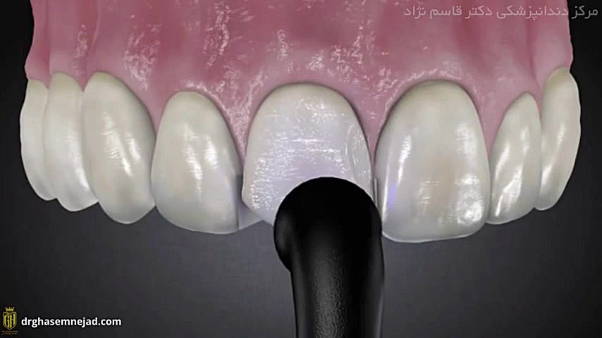 مراحل انجام کامپوزیت دندان دندانپزشکی زیبایی دکتر قاسم نژاد