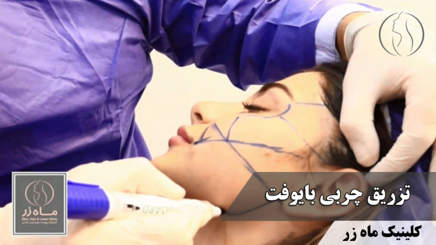 زاویه سازی، حجم دهی و جوانسازی صورت با تزریق چربی بایوفت ( کلینیک ماه زر ) ارتودنسی