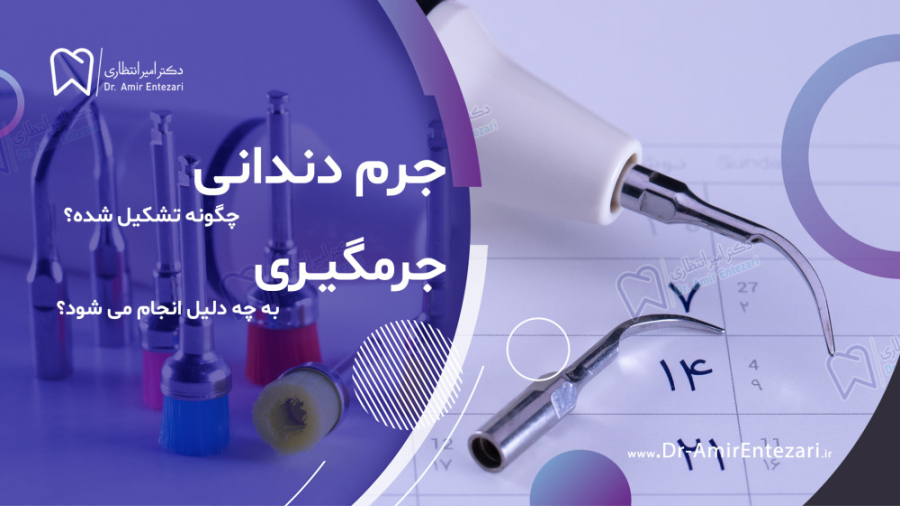 جرم دندانی چگونه تشکیل میشود ؟ چرا جرمگیری دندان ؟ دکتر امیر انتظاری