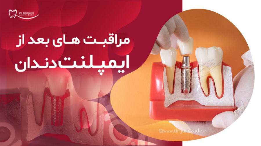 نکات پس از جراحی ایمپلنت دکتر مرضیه جلال زاده