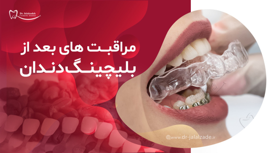 نکات پس از درمان بلیچینگ دکتر مرضیه جلال زاده