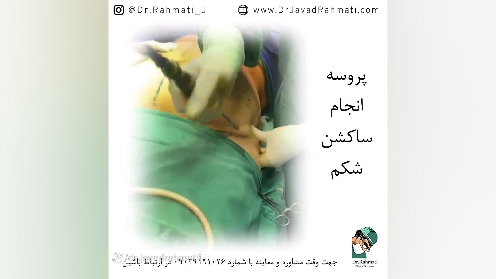 فیلم واقعی ساکشن شکم دکتر جواد رحمتی