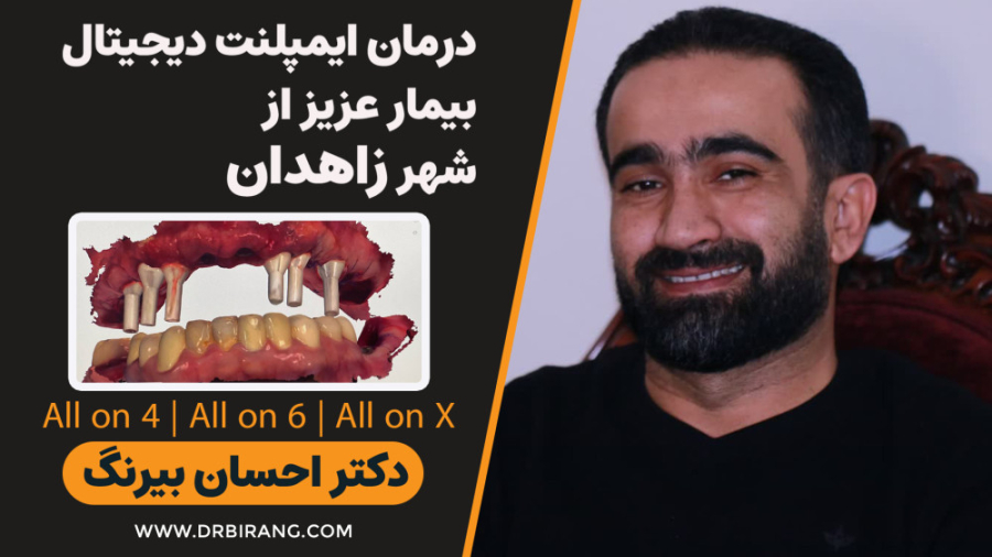 ایمپلنت دیجیتال بیمار عزیز از زاهدان | در یک جلسه | دکتر احسان بیرنگ دکتر احسان بیرنگ