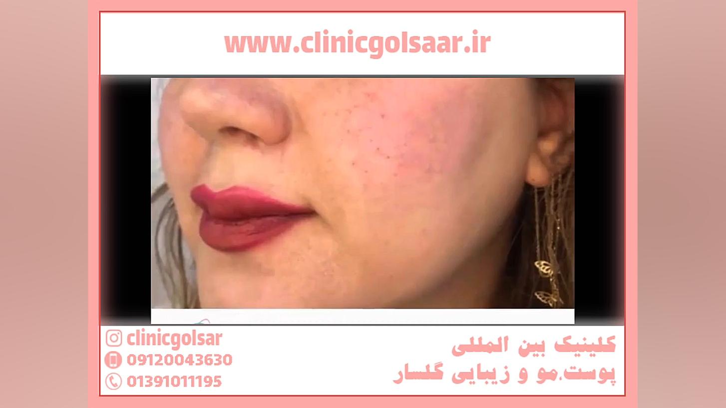 تزریق ژل گونه برای صورت کشیده دستگاه DNA-Chip