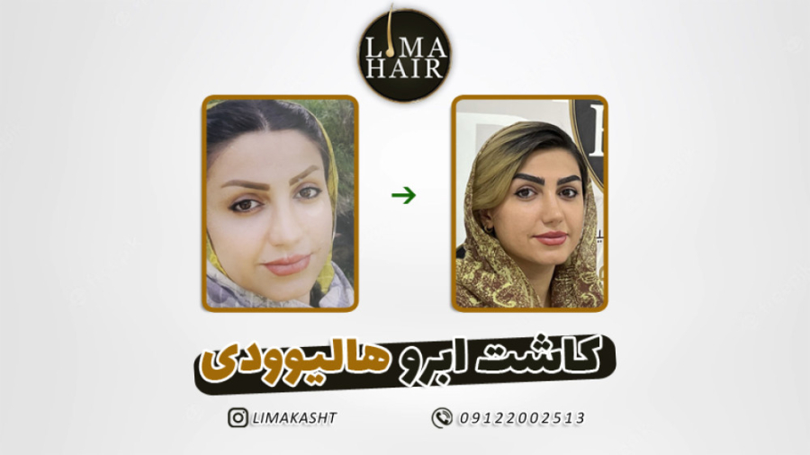 کاشت ابرو طبیعی - لیما کاشت دستگاه آنالیز ایمیجینگ سلول زنده