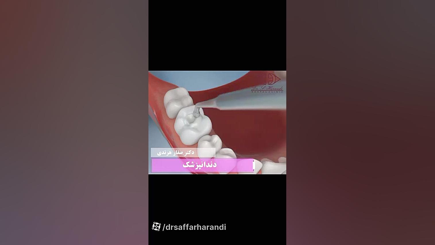 ترمیم دندان با کامپوزیت الکترود اپتوژنزی