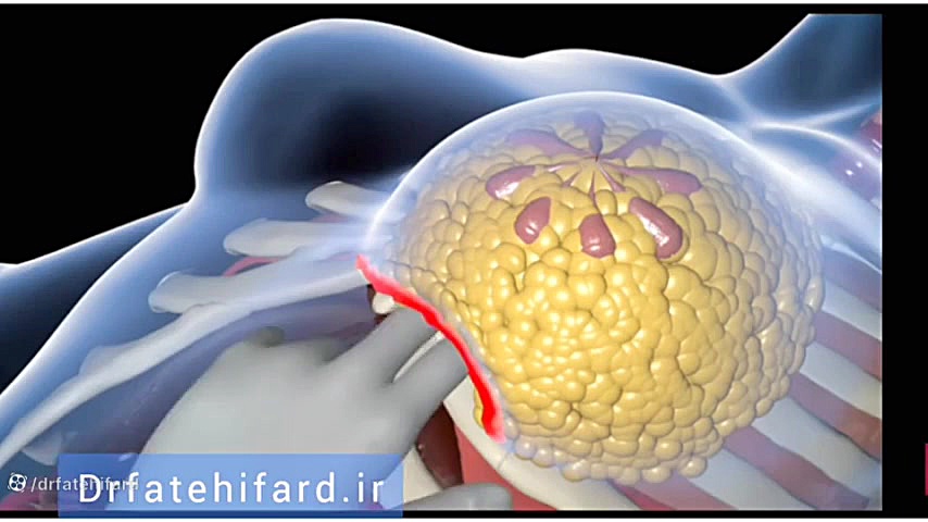 جراحی پروتز سینه | پروتز پستان اصفهان MRCP