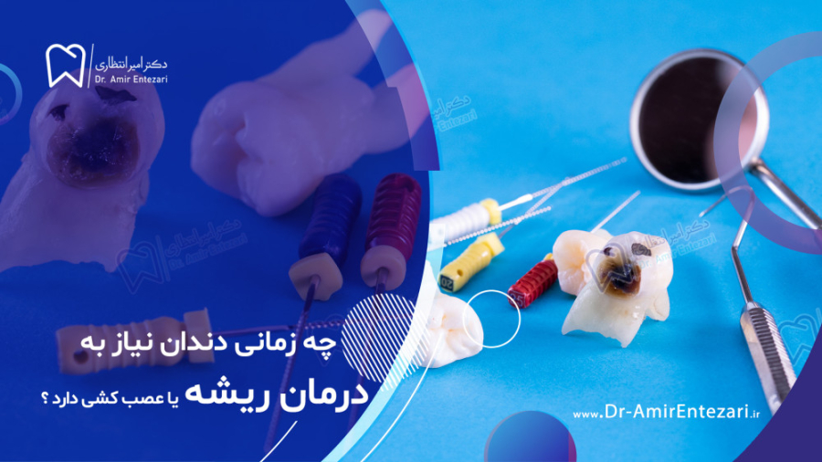 درمان ریشه یا عصب کشی دندان چه زمانی انجام میشود ؟ آزمایش شمارش رتیکولوسیت