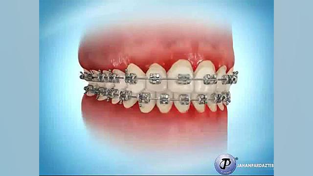 استفاده از برس بین دندانی ارتودنسی دکتر مهیار ماهوش محمدی | متخصص ارتودنسی