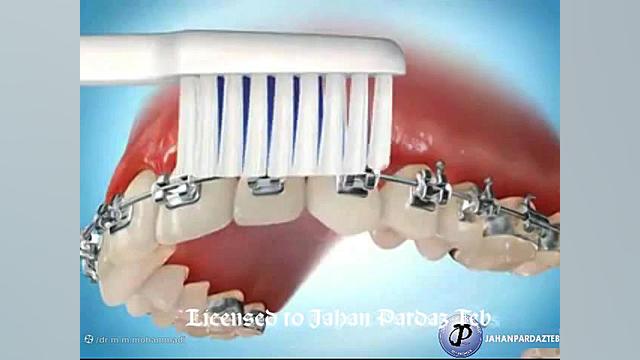 روش صحیح مسواک زدن در ارتودنسی ارتودنسی دکتر مهیار ماهوش محمدی | متخصص ارتودنسی