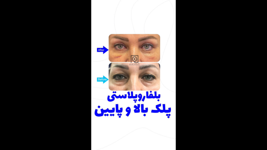 فیلم نتیجه عمل بلفاروپلاستی پلک بالا و پایین عکس قبل و بعد جرمگیری