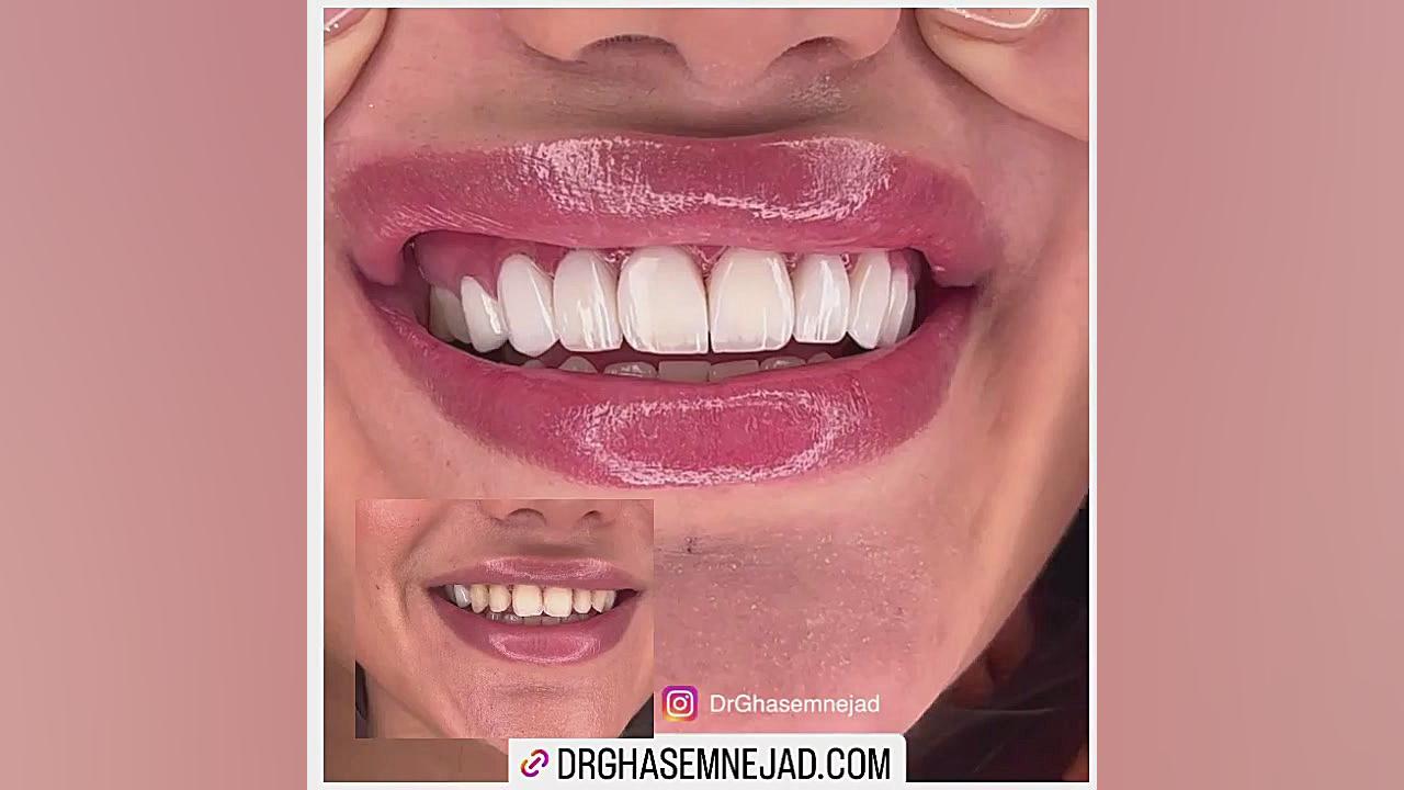کامپوزیت لبه شیسه ای و براق دندان دندانپزشکی زیبایی دکتر قاسم نژاد