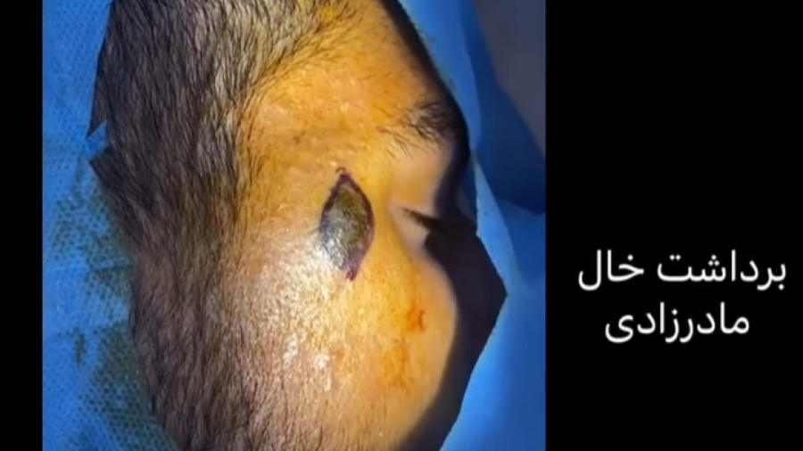 برداشت خال مادرزادی دکتر جواد رحمتی
