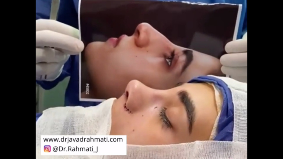 جراحی بینی استخوانی دکتر جواد رحمتی