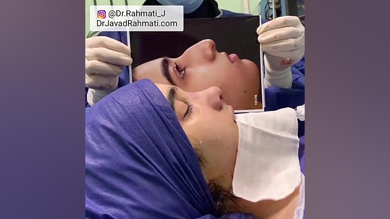 جراحی بینی عروسکی | دکتر جواد رحمتی دکتر جواد رحمتی