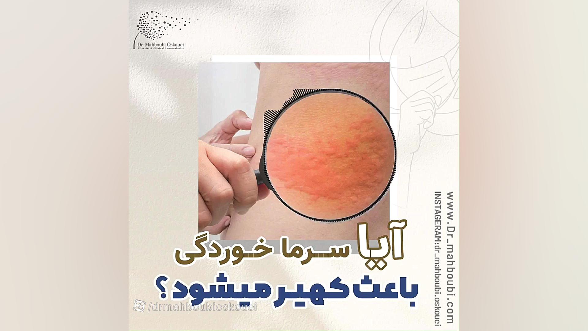 مگه سرماخوردگی ام باعث ایجاد کهیر میشه؟! دکتر یعقوب محبوبی اسکوئی