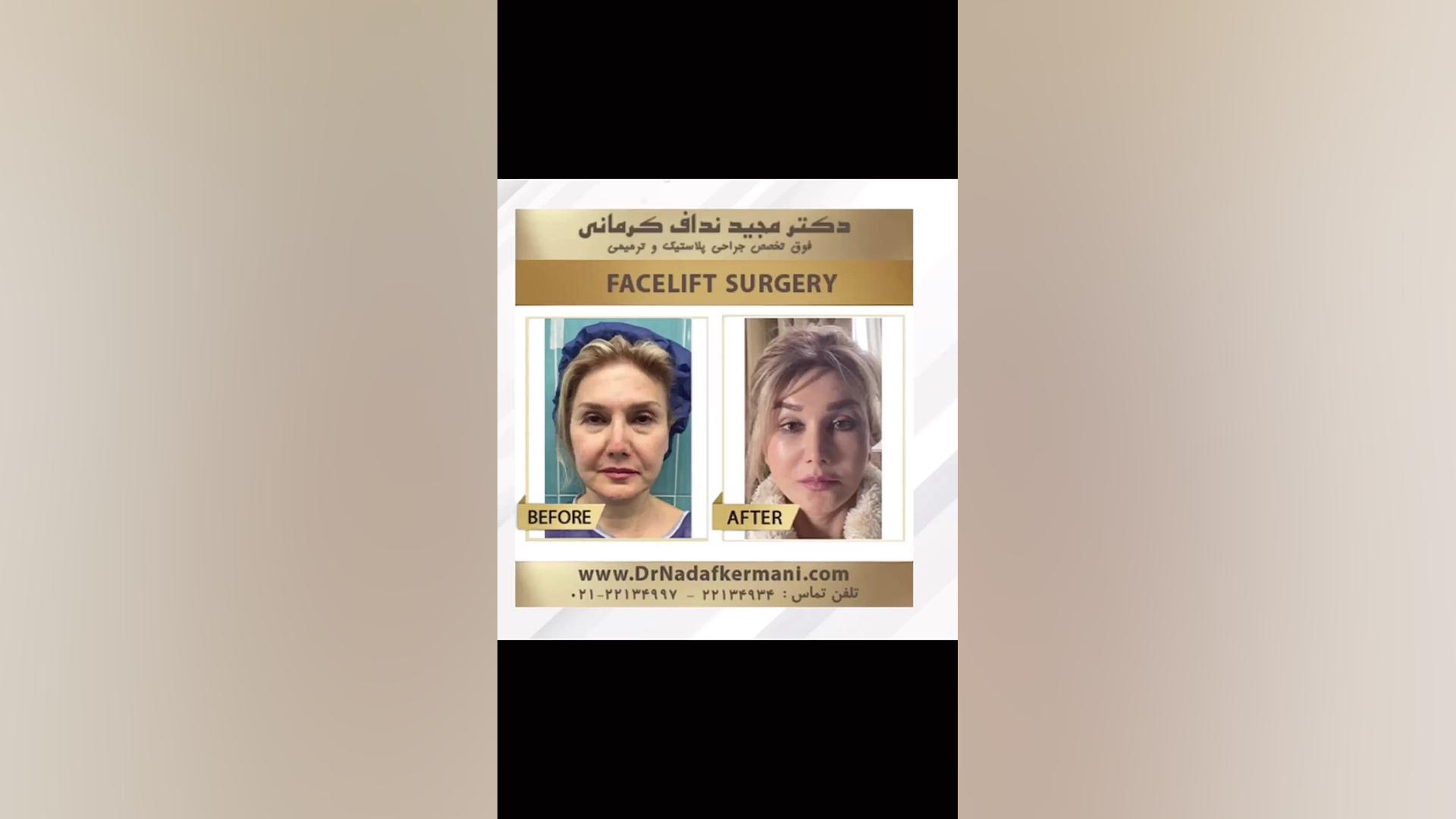 نمونه جراحی های لیفت ابرو و صورت و گردن به همراه بلفاروپلاستی بروموکریپتین