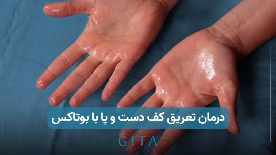 درمان تعریق کف دست و پا با بوتاکس آر اف فرکشنال