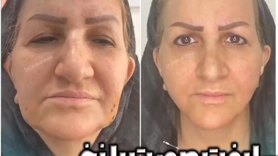 لیفت صورت با نخ و تزریق فیلر دکتر فرشاد رحیمی