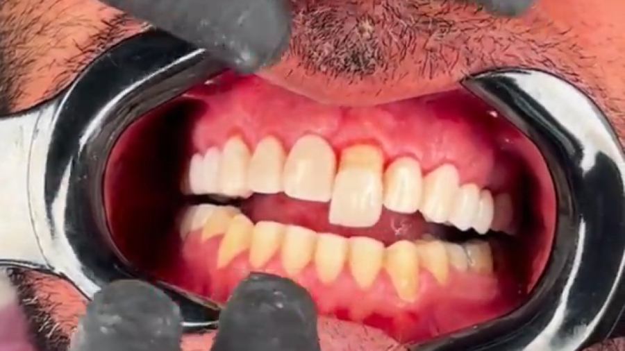 لمینت دندان از نمای نزدیک دکتر قاسم نژاد دندانپزشکی زیبایی دکتر قاسم نژاد