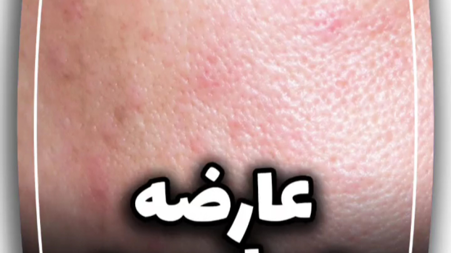 حساسیت پوستی چیه؟ بیماری کلوتزوکس