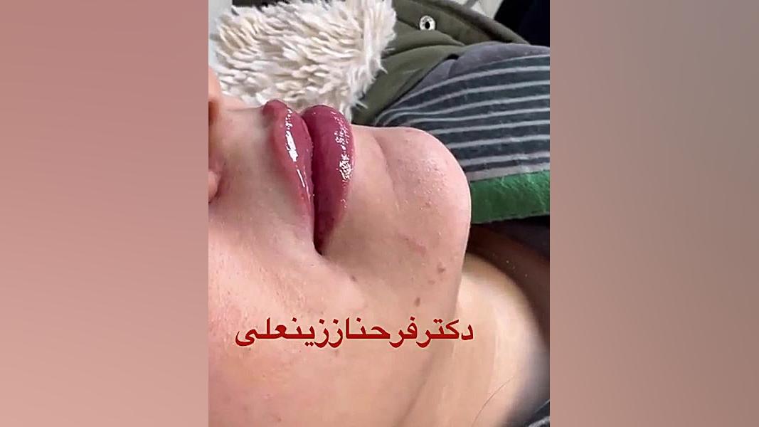 فیلم لب قبل وبعد از تزریق کمتر از یک سی سی ژل لب کره ای با متد روسی دکتر فرحناز زینعلی - متخصص پوست، مو، زیبایی زنجان