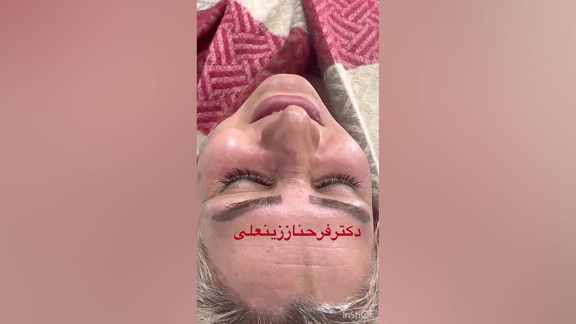 نتیجه تزریق چربی به گونه ها در بیست ماه پیش دکتر فرحناز زینعلی - متخصص پوست، مو، زیبایی زنجان
