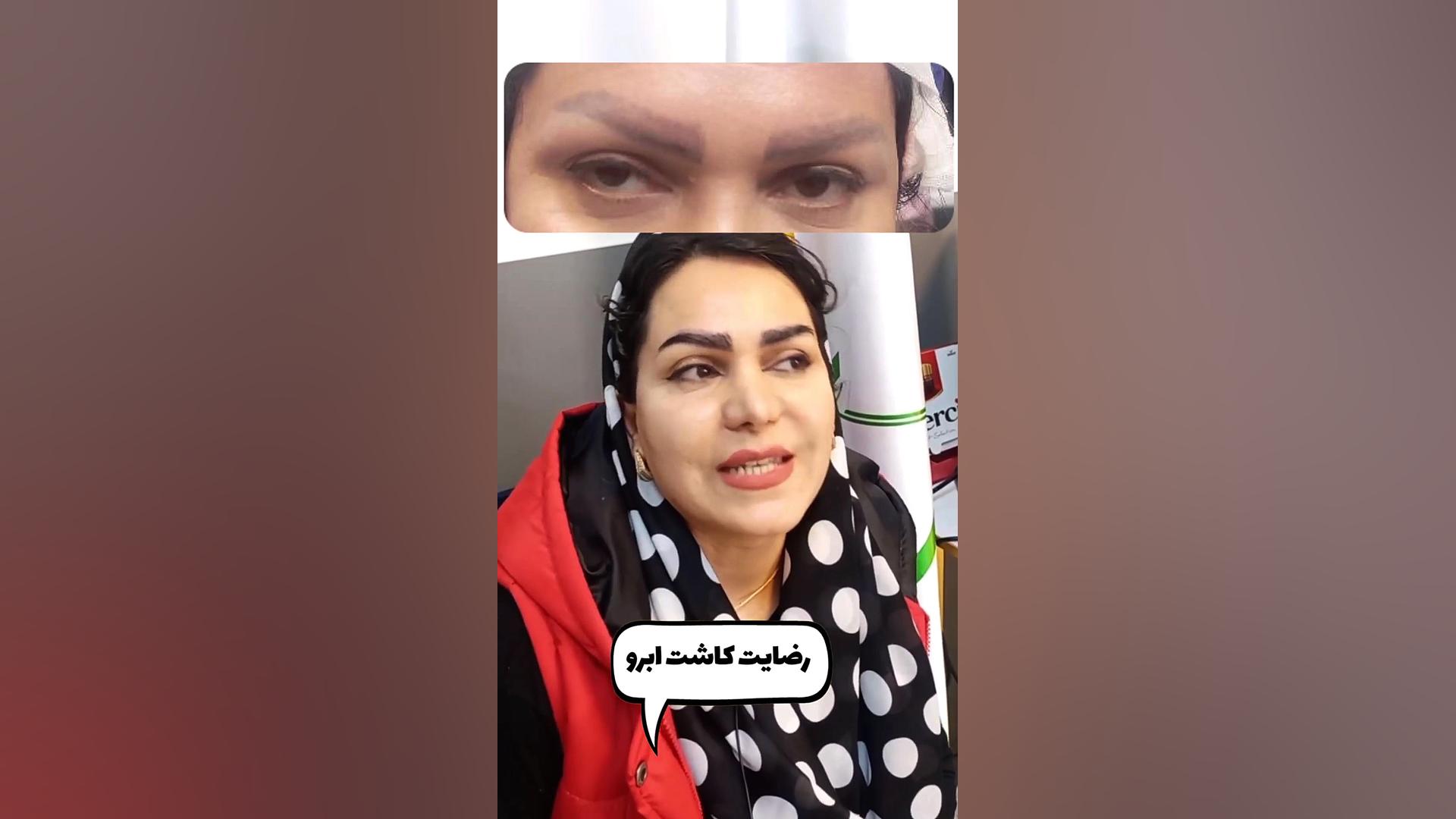 رضایت زیباجوی عزیز از کاشت ابرو طبیعی در کلینیک بین المللی گلبان مایکروگناتیا