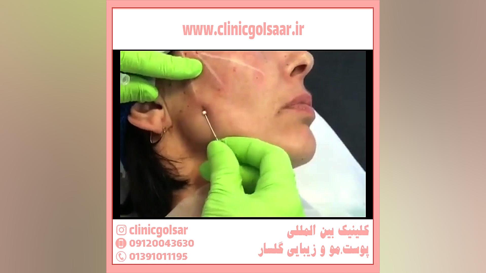 لیفت صورت با نخ چقدر هزینه دارد؟ کشیدن دندان