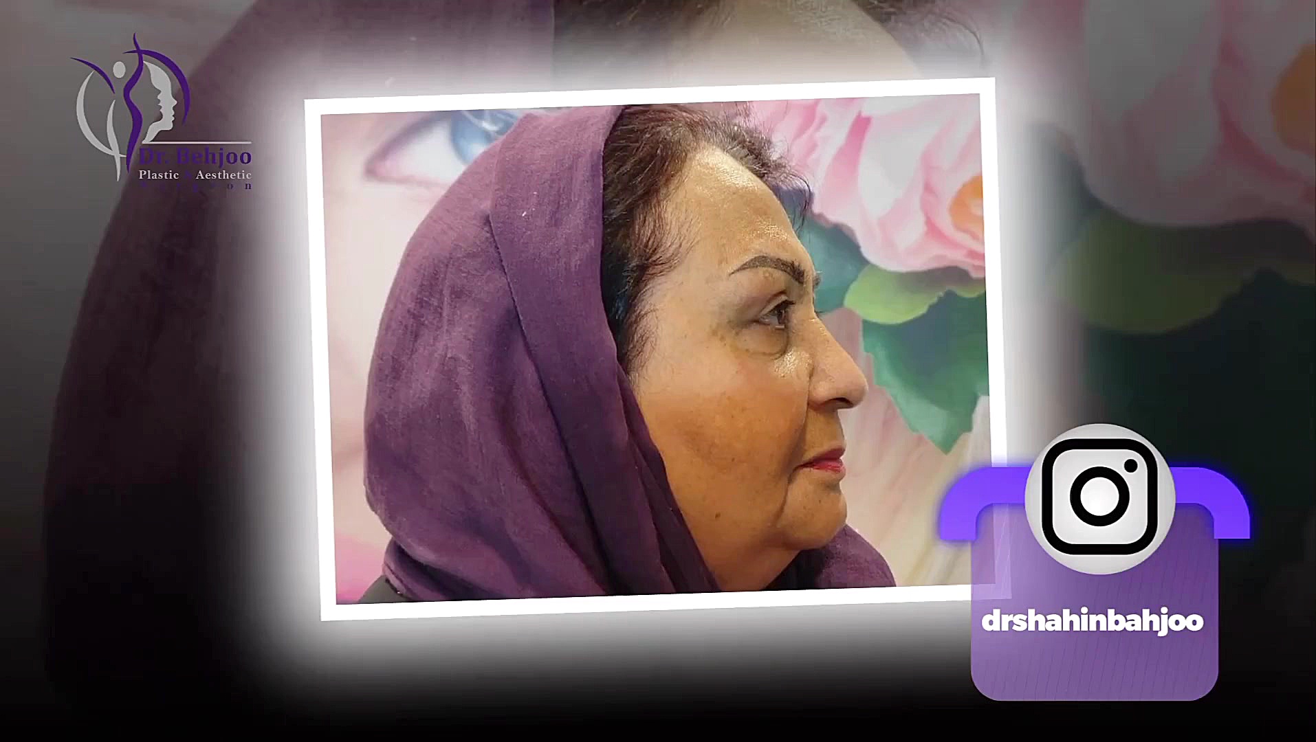 یک هفته بعد از بلفاروپلاستی پلک فوقانی دکتر شاهین بهجو - فوق تخصص جراحی پلاستیک