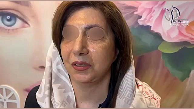 ۳ ماه بعد از لیفت میانی صورت و گردن دکتر شاهین بهجو - فوق تخصص جراحی پلاستیک
