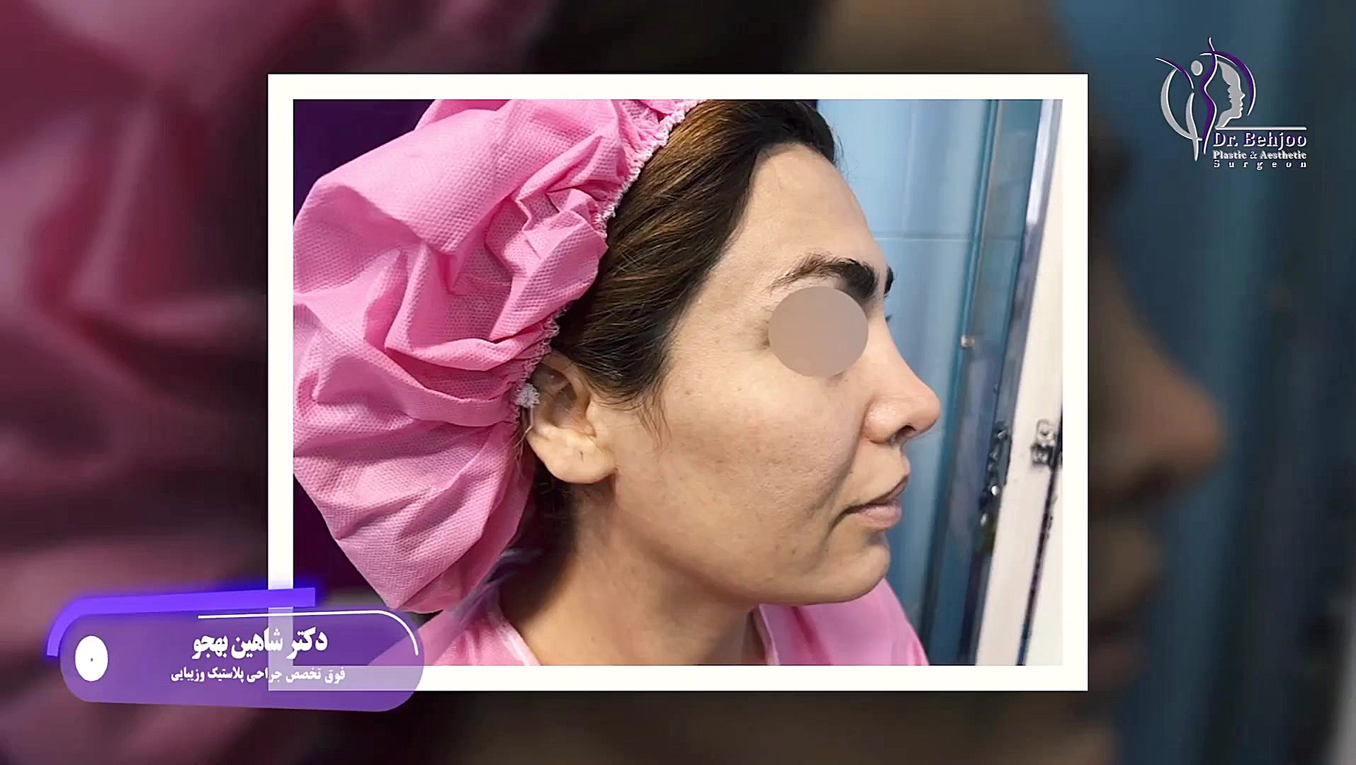 جراحی لیفت اندوسکوپی ابرو و پیشانی و اینهمه تغییییییییییییییییر دکتر شاهین بهجو - فوق تخصص جراحی پلاستیک