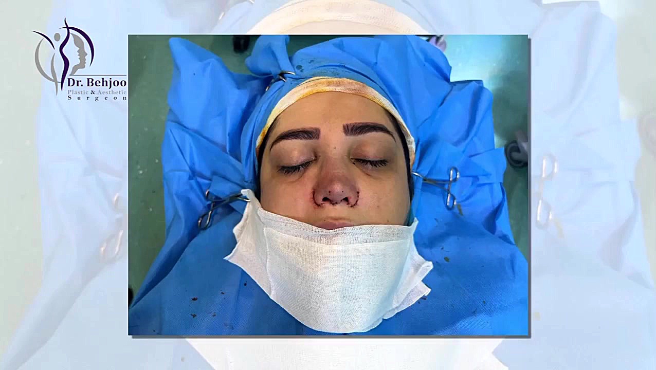 زیباترین فرم بینی نیمه فانتری دکتر شاهین بهجو - فوق تخصص جراحی پلاستیک
