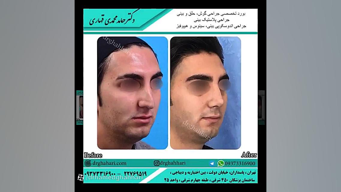 فیلم رینوپلاستی بینی دکتر حامد محمدی قهاری
