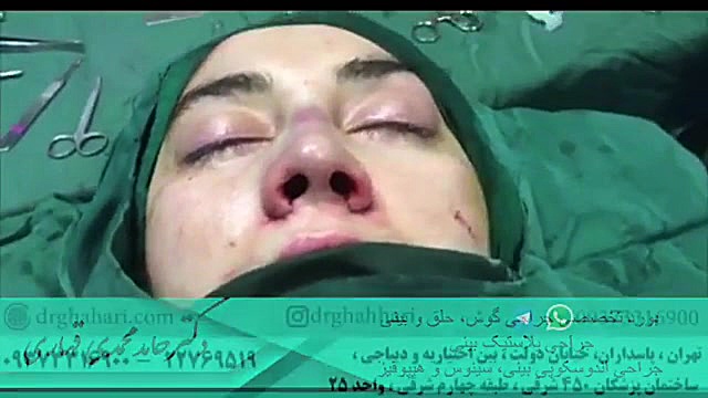 فیلم عمل رینوپلاستی بینی دکتر حامد محمدی قهاری