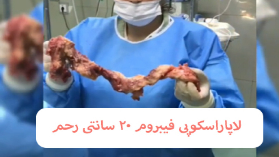 لاپاراسکوپی فیبروم 20 سانتی رحم اصلاح فرم صورت