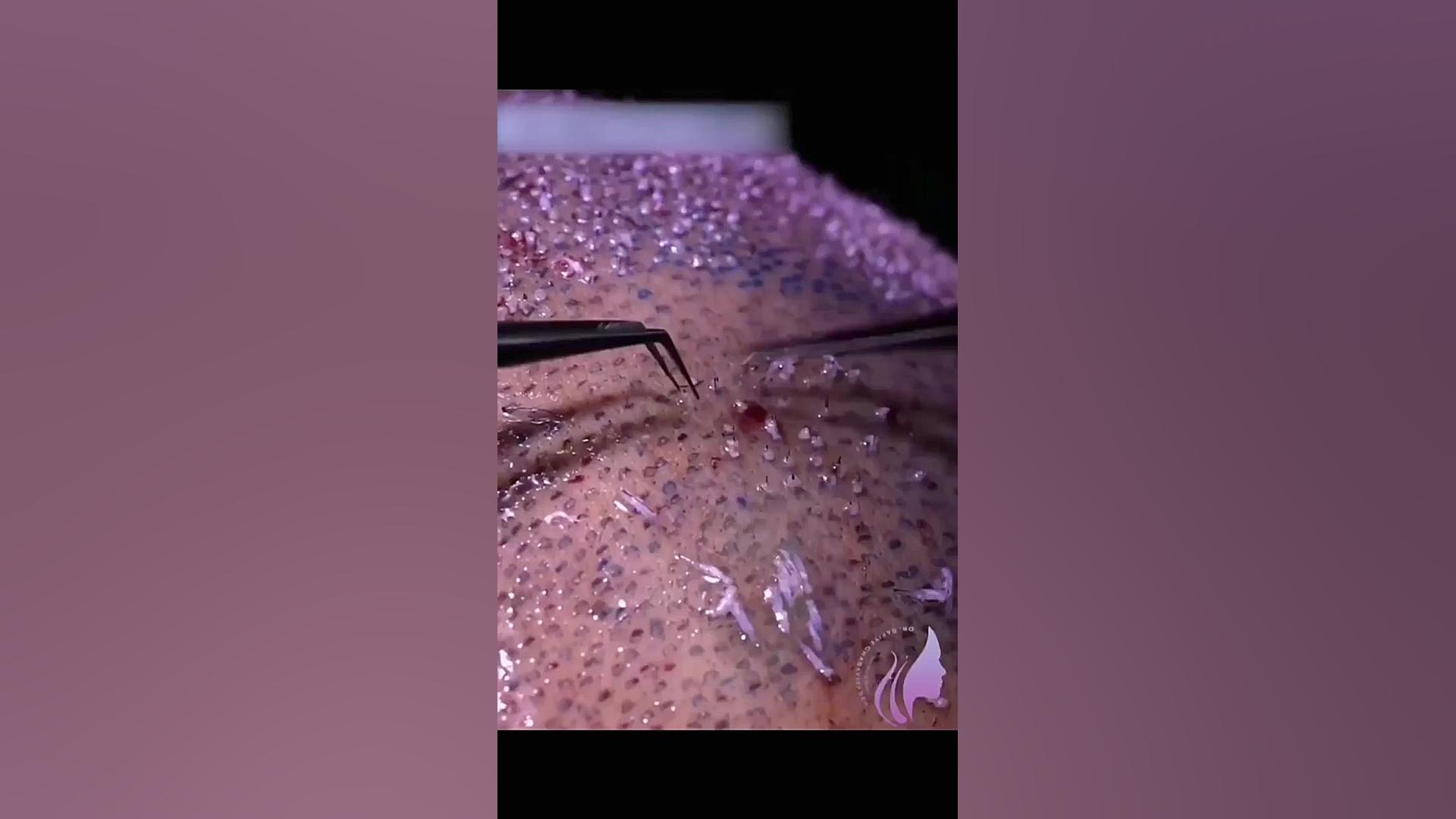 نحوه کاشت مو دکتر صفیه چعباوی زاده