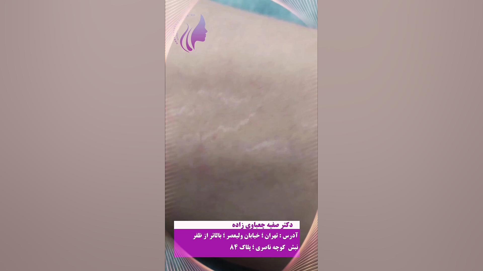 لیزر آر اف فرکشنال برای از بین بردن خطوط رشد دکتر صفیه چعباوی زاده
