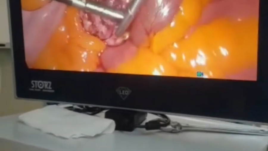 لاپاراسکوپی فیبروم رحم خانم 38 ساله لیپوست