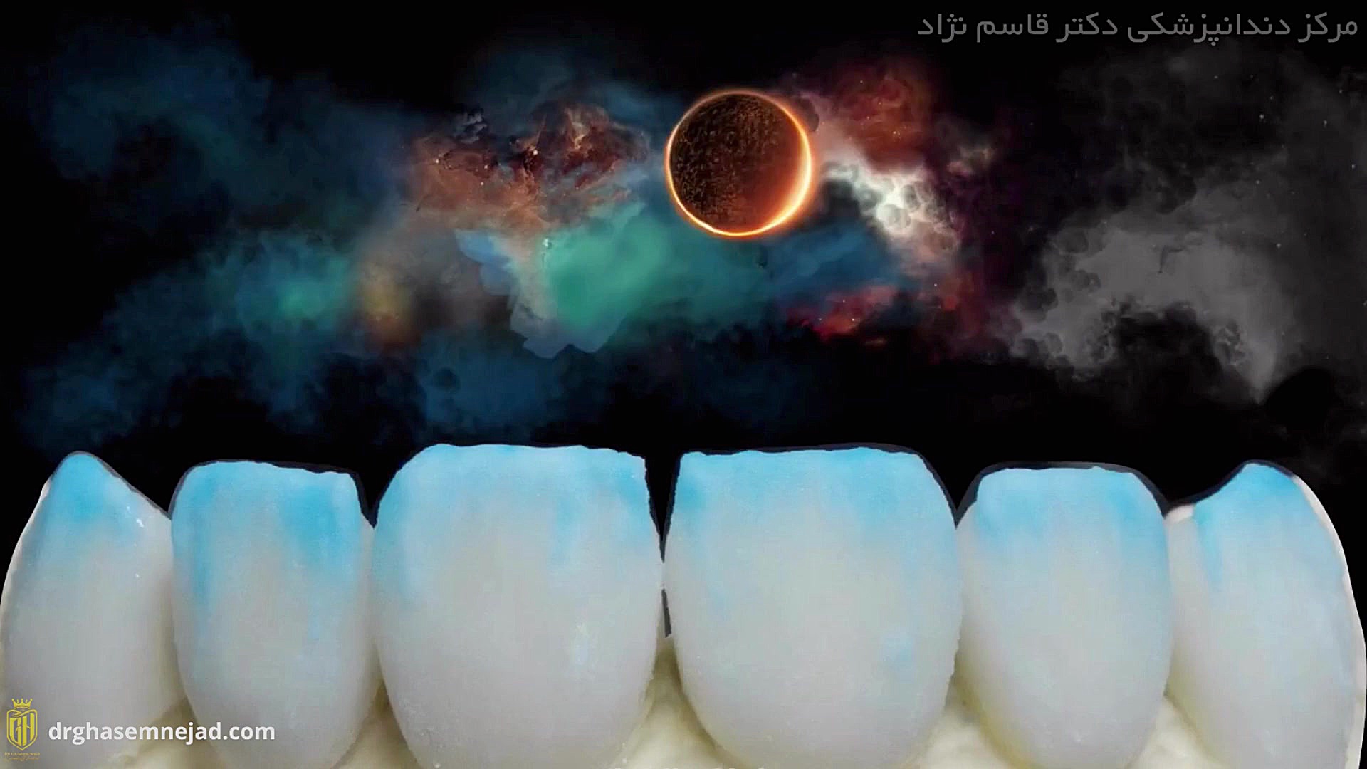 لیرینگ دندان دندانپزشکی زیبایی دکتر قاسم نژاد