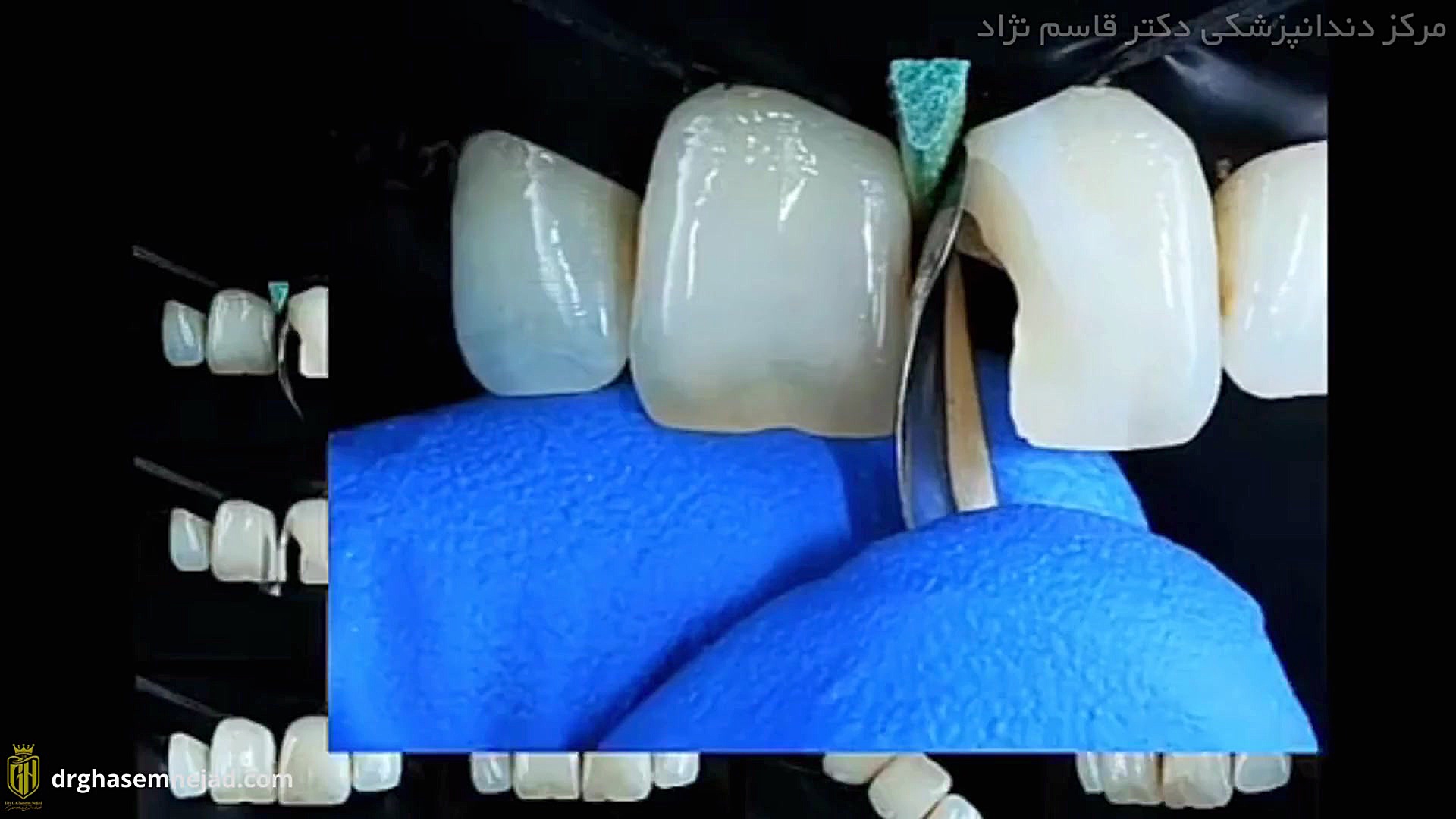 فیلم کامپوزیت لیرینگ دندان دندانپزشکی زیبایی دکتر قاسم نژاد