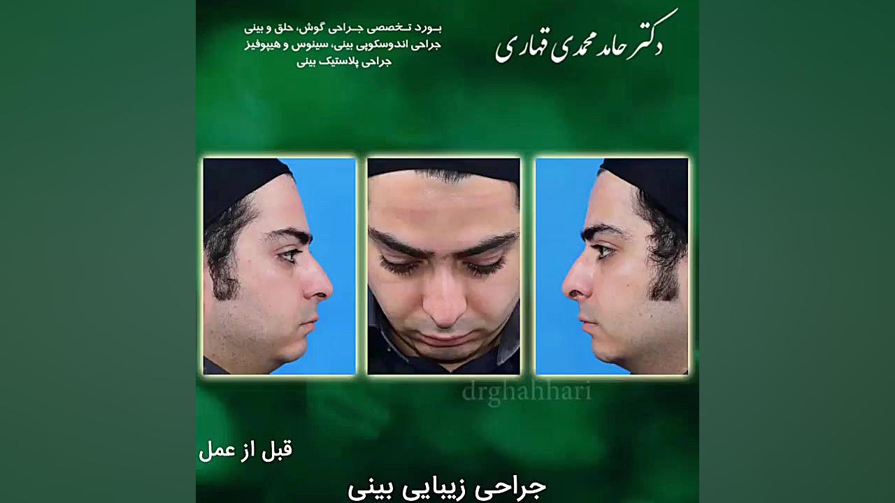 پیزوسرجری بینی دکتر حامد محمدی قهاری