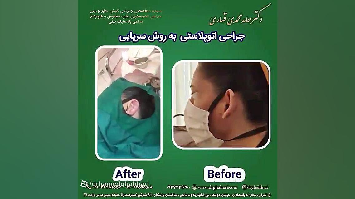 فیلم اتوپلاستی گوش دکتر حامد محمدی قهاری