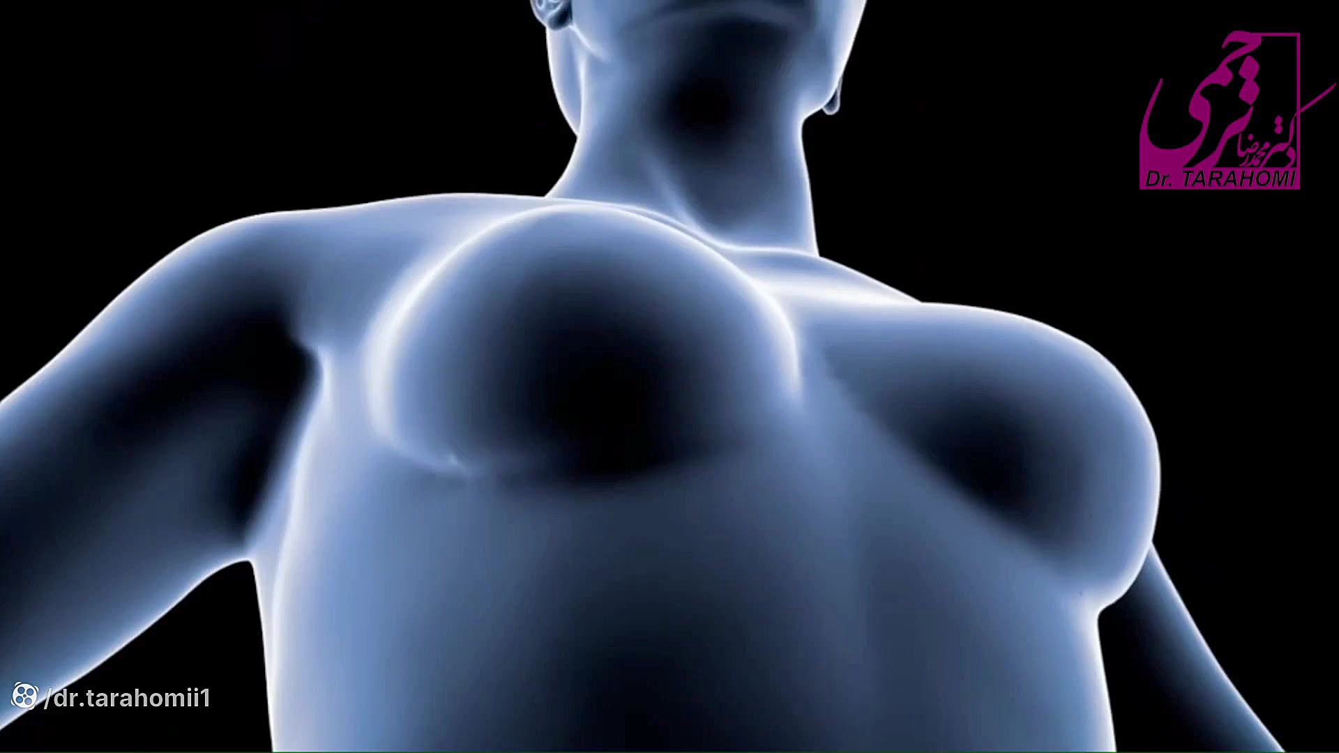انیمیشن جراحی پروتز سینه نوروپروستتیک