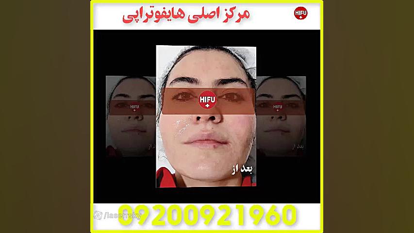 مرکز اصلی هایفوتراپی کامپوزیت ونیر