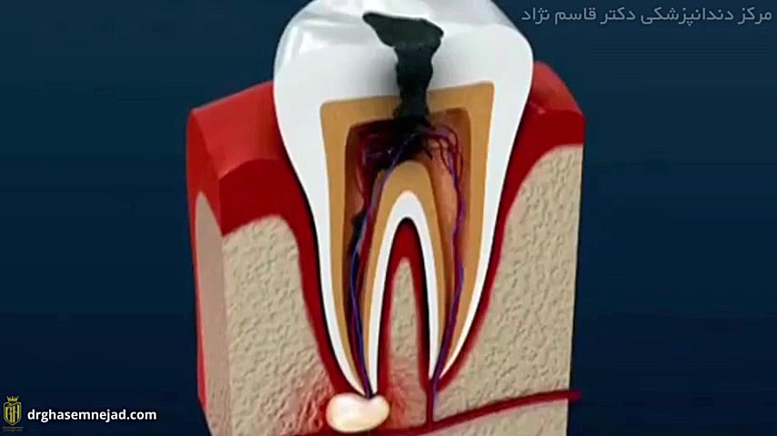 پوسیدگی دندان تریلوسوماب