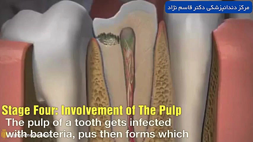 پوسیدگی دندان تریلر تصویربرداری بالینی