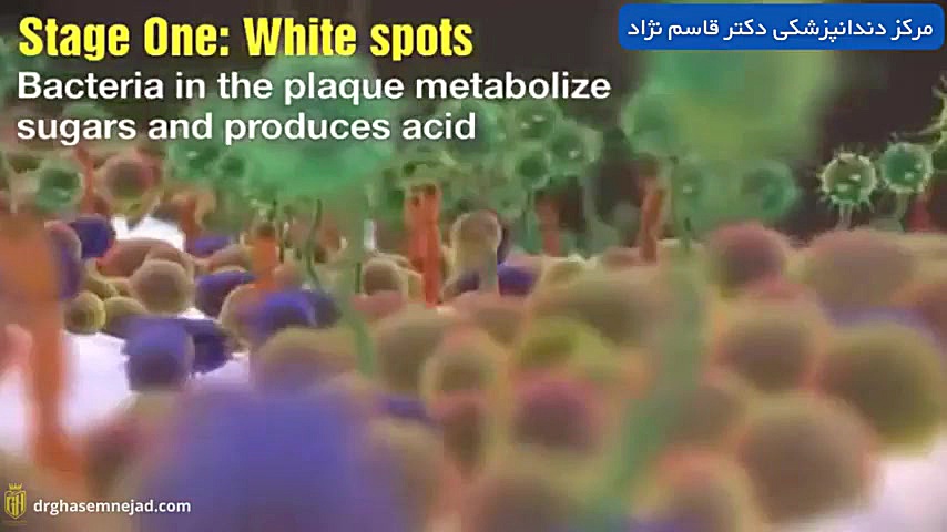 پوسیدگی دندان تالاسمی دلتا-بتا
