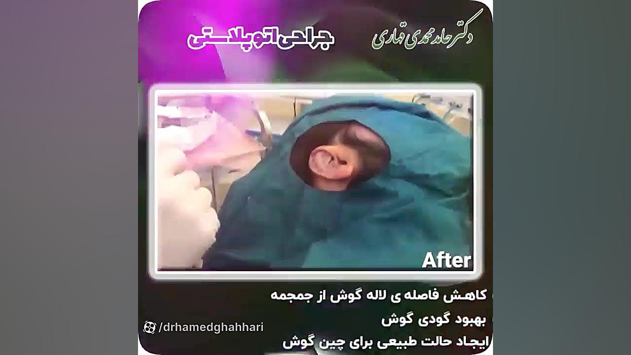 فیلم جراحی گوش برجسته دکتر حامد محمدی قهاری