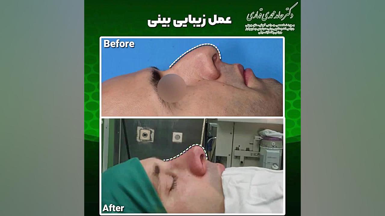 هزینه عمل بینی پیزو دکتر حامد محمدی قهاری